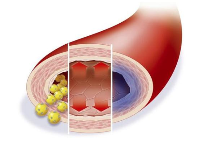 低密度膽固醇超標(biāo)，多久會影響血管健康？來看看鹽城康復(fù)醫(yī)院醫(yī)生怎么說